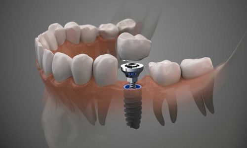 DentalImplant-AdobeStock_262324327 DentalImplant-AdobeStock_262324327